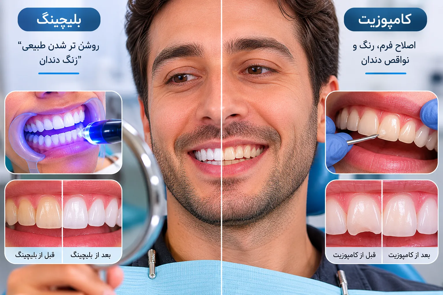 تفاوت بلیچینگ (سفید کردن) و کامپوزیت دندان در چیست؟ 