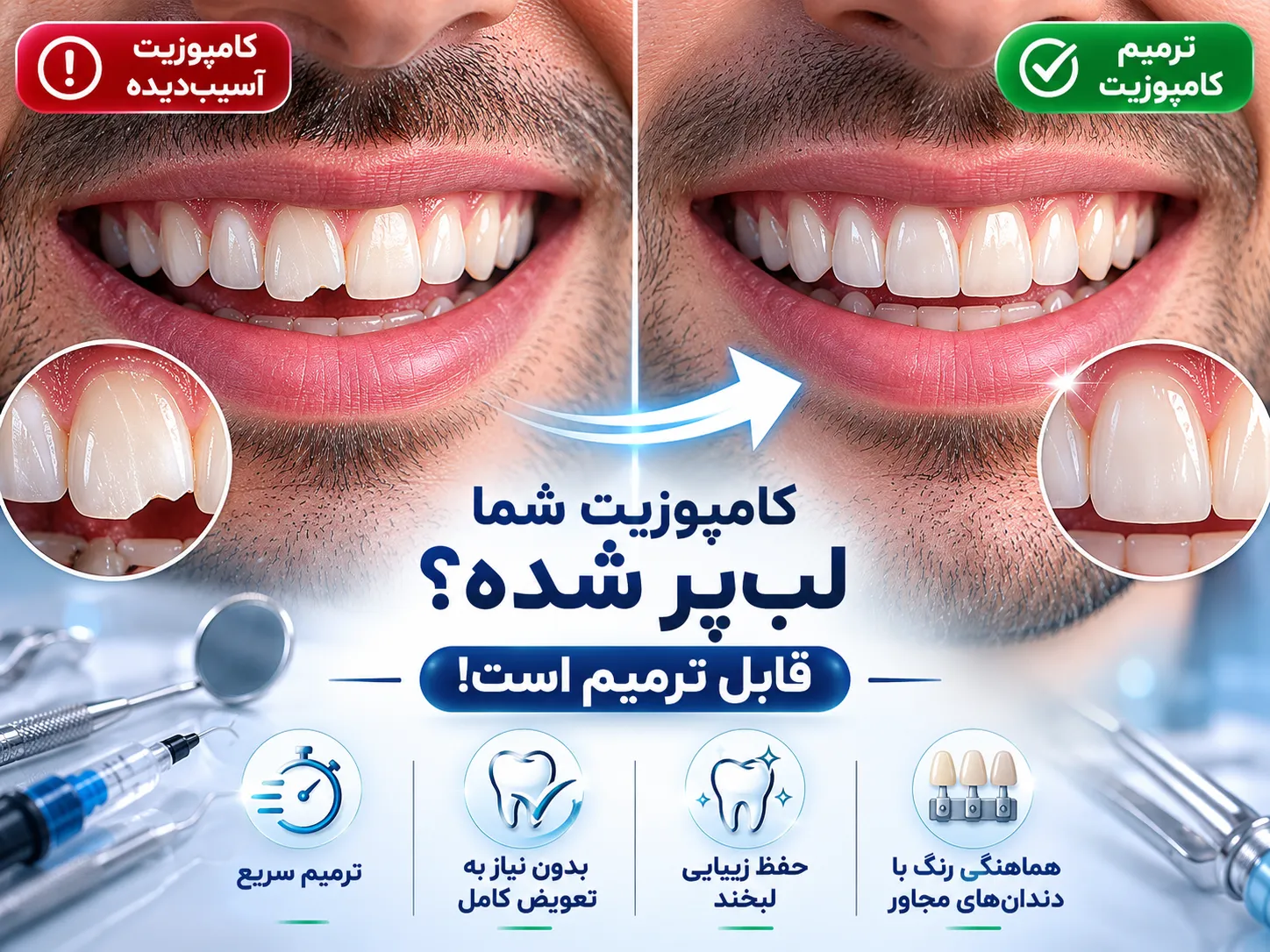 ترمیم کامپوزیت شکسته یا لب‌پر شده؛ آیا کامپوزیت قابل ترمیم است؟ کامپوزیت شکسته یا لب پر شده در اغلب موارد قابل ترمیم است و نیازی به تعویض کامل ندارد مگر اینکه آسیب گسترده یا طراحی اولیه نادرست باشد.