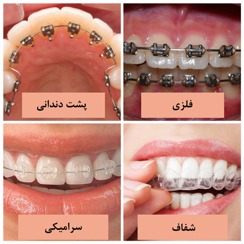 ارتودنسی دندان
