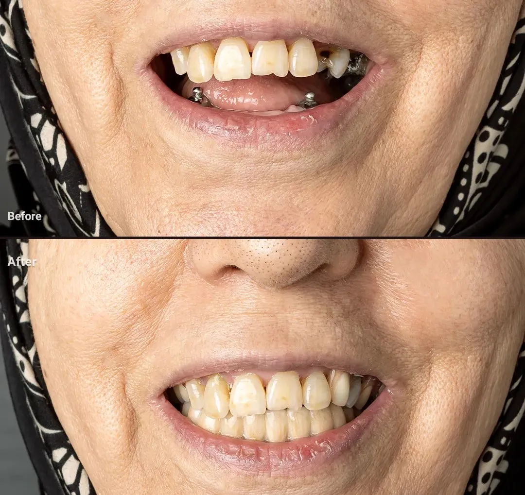 لمینیت دندان